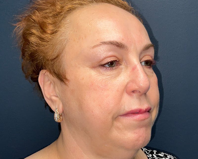 Blepharoplasty Before & After Gallery - Patient 177734 - Image 3
