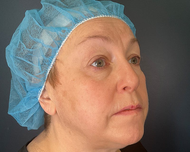 Blepharoplasty Before & After Gallery - Patient 177734 - Image 4