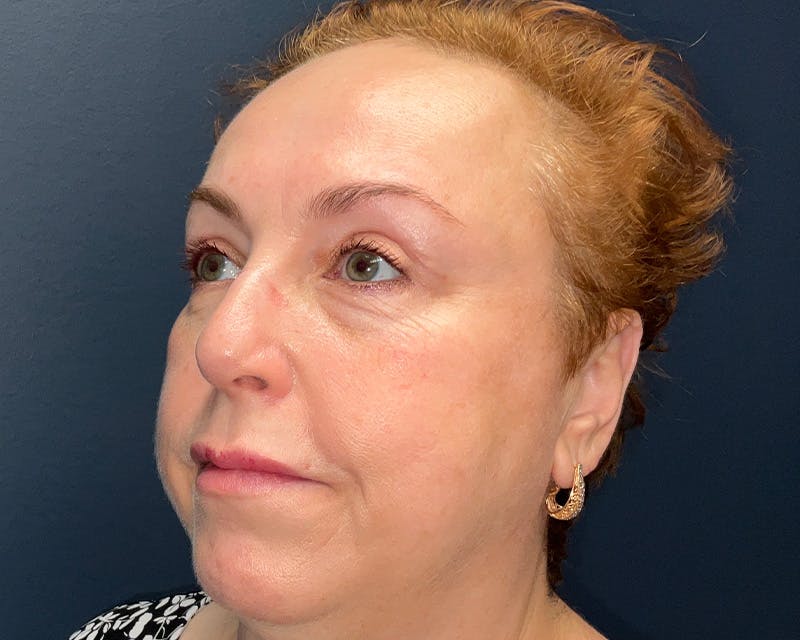 Blepharoplasty Before & After Gallery - Patient 177734 - Image 5