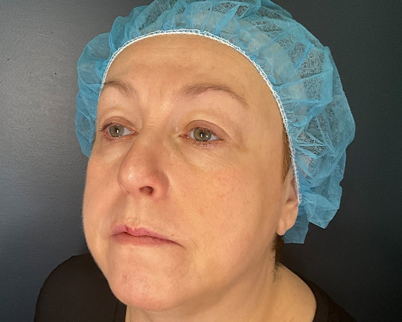 Blepharoplasty Before & After Gallery - Patient 177734 - Image 6