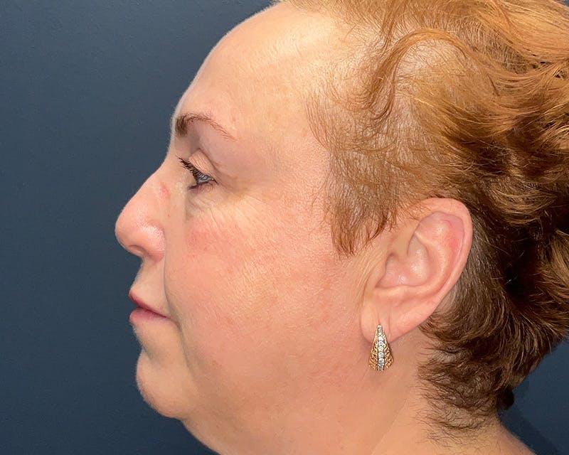 Blepharoplasty Before & After Gallery - Patient 177734 - Image 7