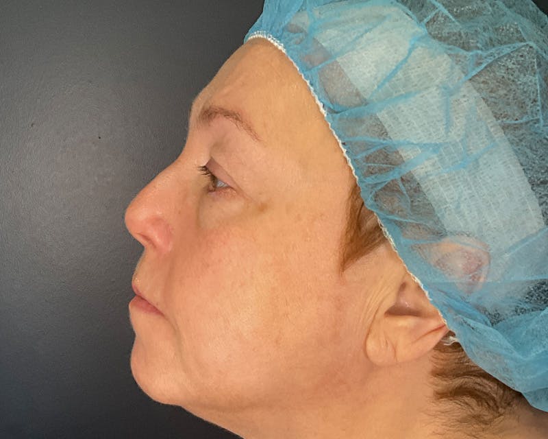 Blepharoplasty Before & After Gallery - Patient 177734 - Image 8