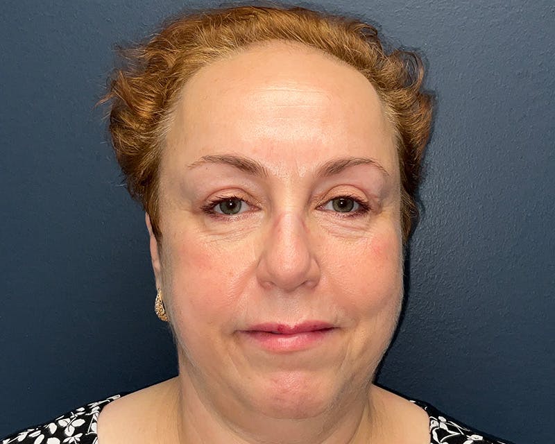 Blepharoplasty Before & After Gallery - Patient 177734 - Image 1