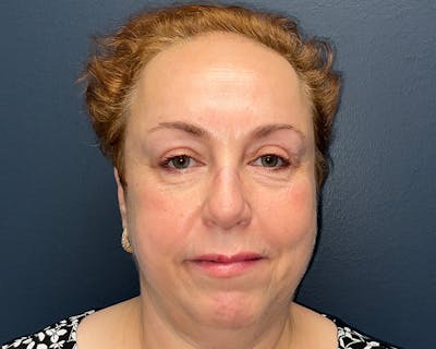 Blepharoplasty Before & After Gallery - Patient 177734 - Image 1