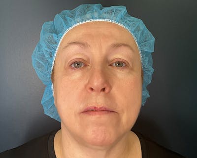 Blepharoplasty Before & After Gallery - Patient 177734 - Image 2