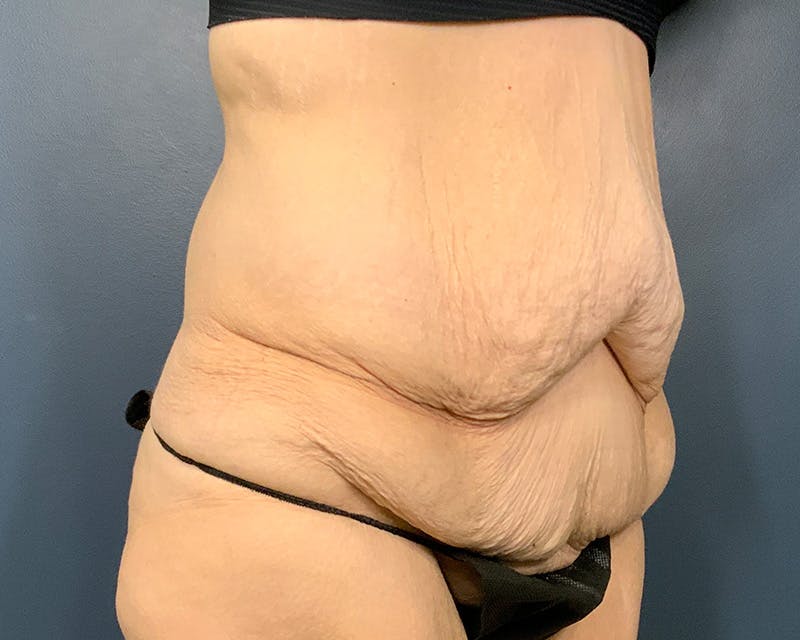 Tummy Tuck Before & After Gallery - Patient 279155 - Image 3