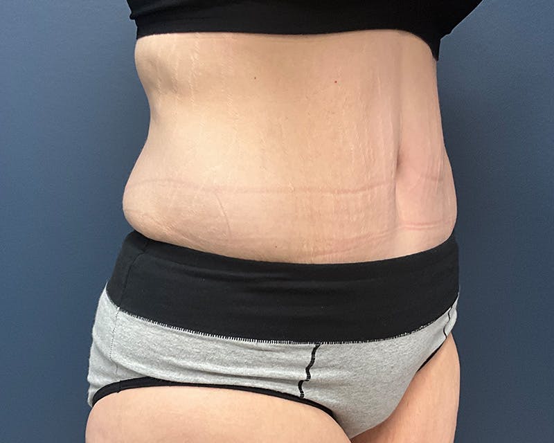 Tummy Tuck Before & After Gallery - Patient 279155 - Image 4