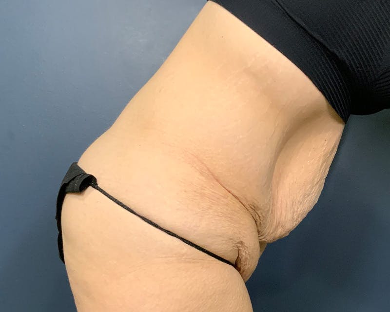 Tummy Tuck Before & After Gallery - Patient 279155 - Image 5
