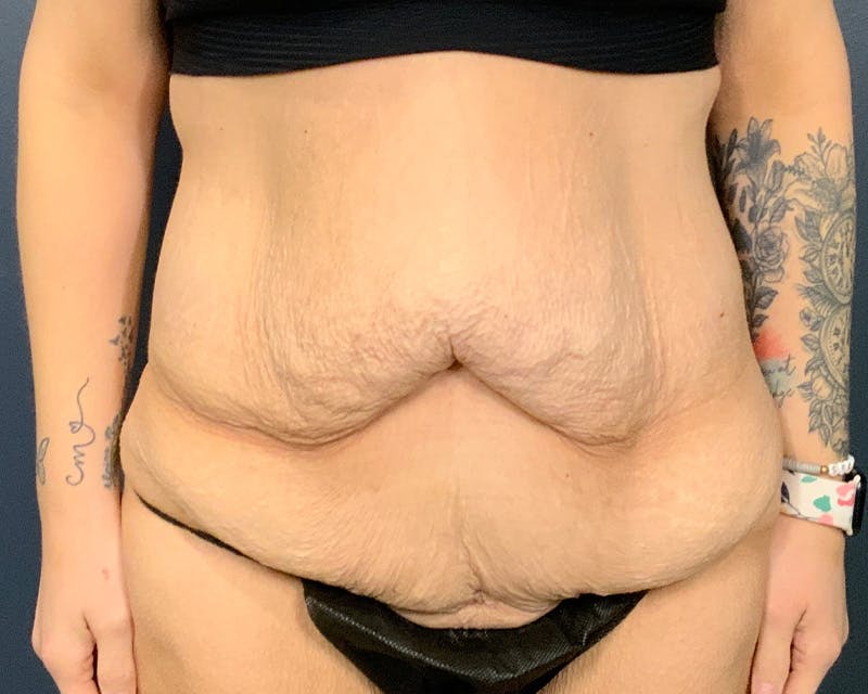 Tummy Tuck Before & After Gallery - Patient 279155 - Image 1