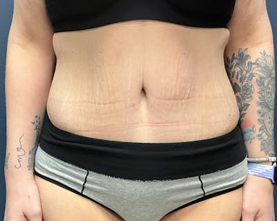 Tummy Tuck Before & After Gallery - Patient 279155 - Image 2