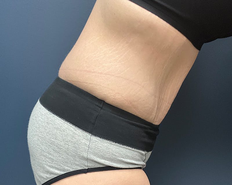 Tummy Tuck Before & After Gallery - Patient 279155 - Image 6