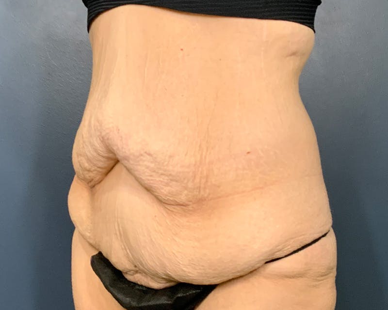Tummy Tuck Before & After Gallery - Patient 279155 - Image 7