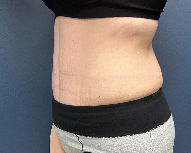 Tummy Tuck Before & After Gallery - Patient 279155 - Image 8