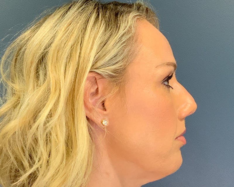Rhinoplasty Before & After Gallery - Patient 236825 - Image 5