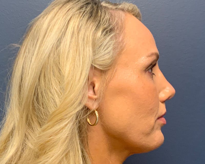 Rhinoplasty Before & After Gallery - Patient 236825 - Image 6