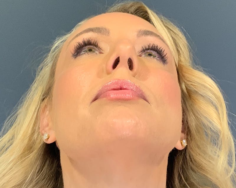 Rhinoplasty Before & After Gallery - Patient 236825 - Image 9