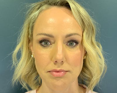 Rhinoplasty Before & After Gallery - Patient 236825 - Image 1