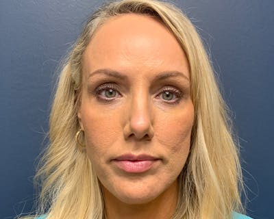 Rhinoplasty Before & After Gallery - Patient 236825 - Image 2