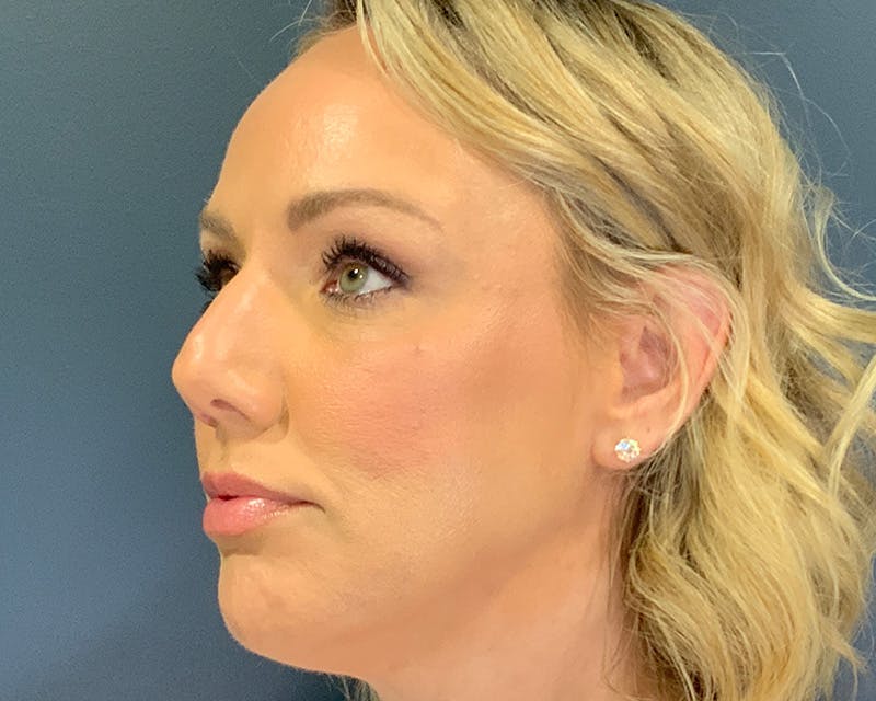 Rhinoplasty Before & After Gallery - Patient 236825 - Image 3