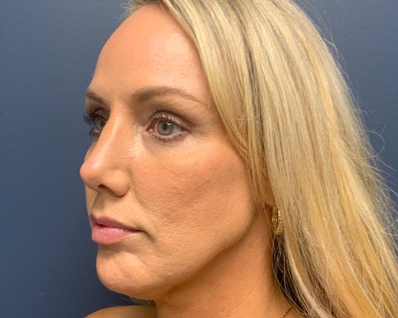 Rhinoplasty Before & After Gallery - Patient 236825 - Image 4