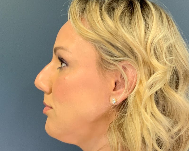 Rhinoplasty Before & After Gallery - Patient 236825 - Image 7