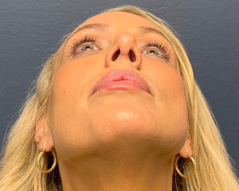 Rhinoplasty Before & After Gallery - Patient 236825 - Image 10