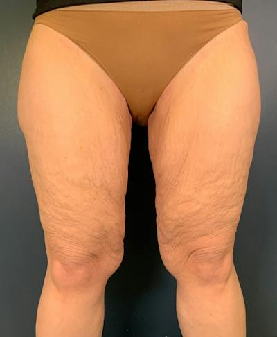Thighplasty Before & After Gallery - Patient 328909 - Image 1