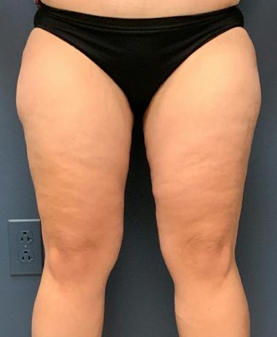 Thighplasty Before & After Gallery - Patient 328909 - Image 2
