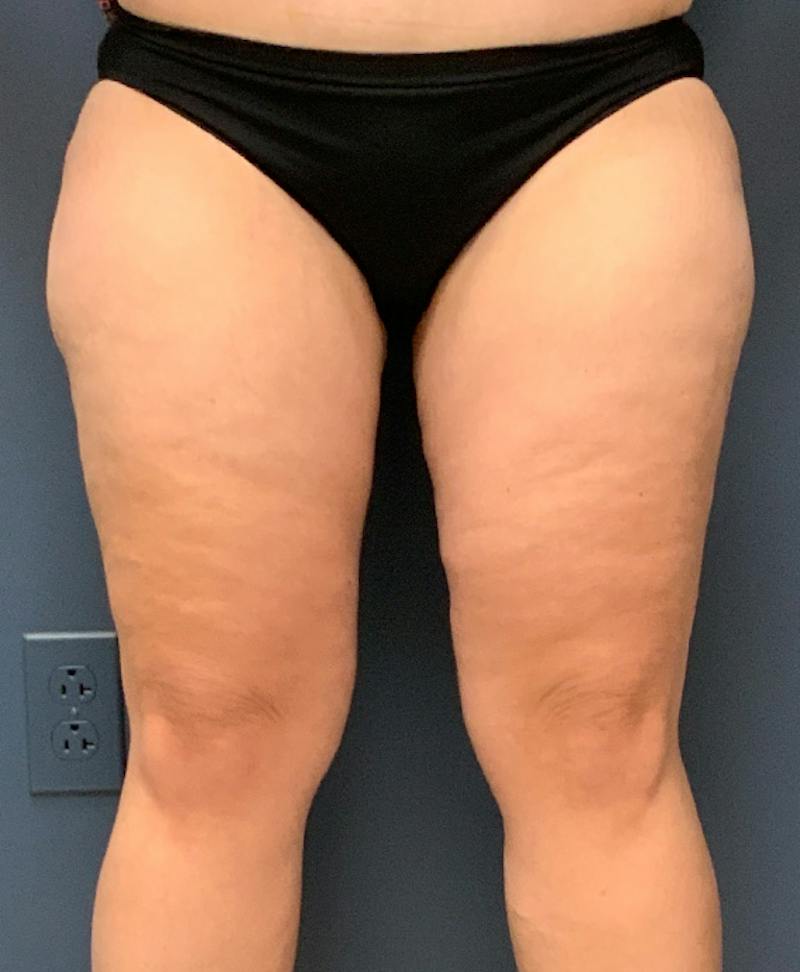 Thighplasty Before & After Gallery - Patient 328909 - Image 2