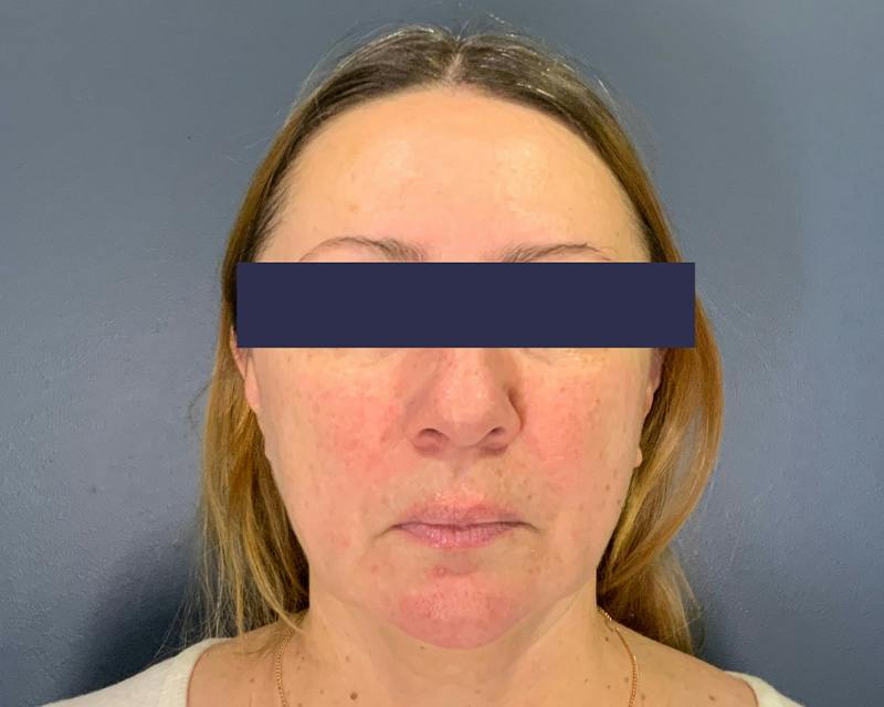Rhinoplasty Before & After Gallery - Patient 164033 - Image 1