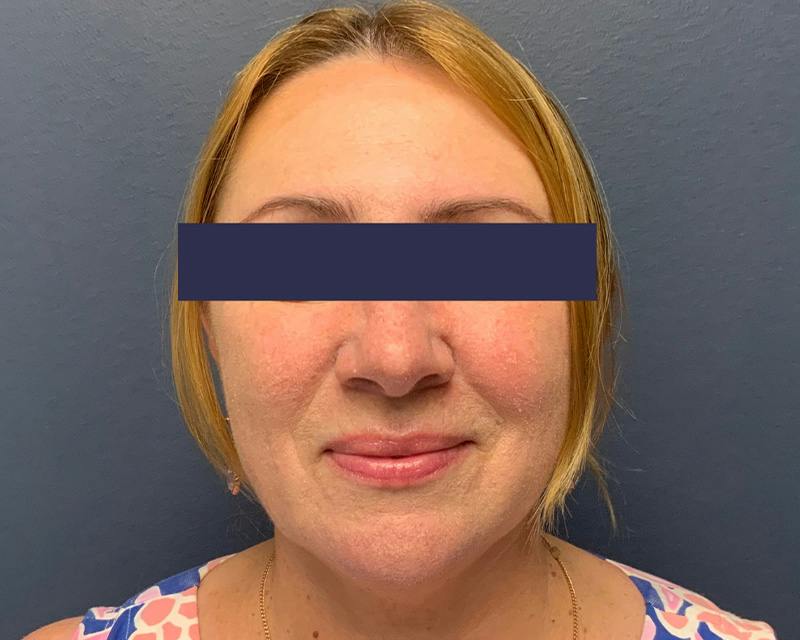 Rhinoplasty Before & After Gallery - Patient 164033 - Image 2