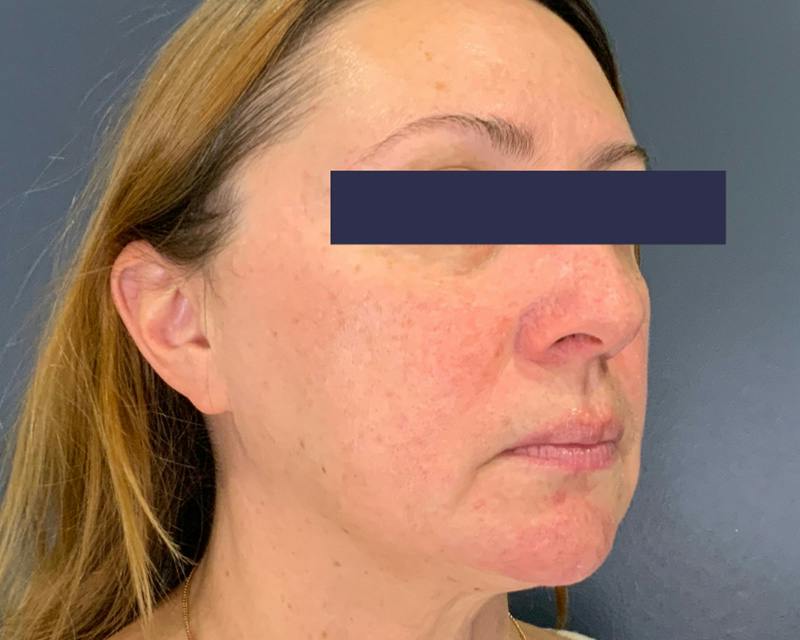 Rhinoplasty Before & After Gallery - Patient 164033 - Image 3