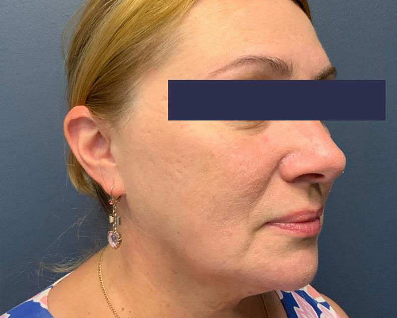 Rhinoplasty Before & After Gallery - Patient 164033 - Image 4