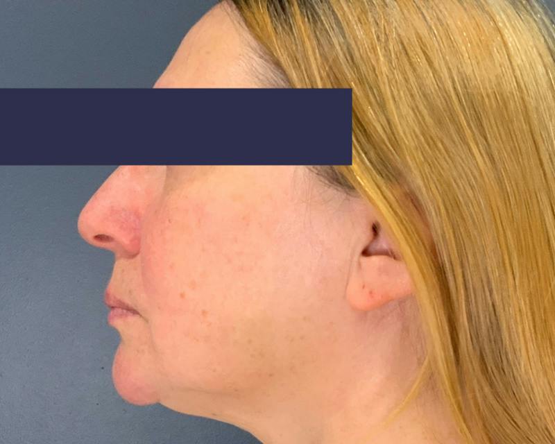 Rhinoplasty Before & After Gallery - Patient 164033 - Image 5