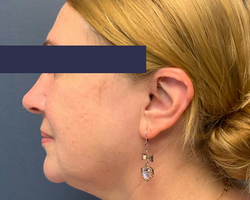 Rhinoplasty Before & After Gallery - Patient 164033 - Image 6