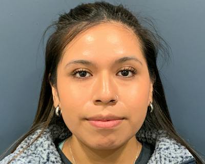 Rhinoplasty Before & After Gallery - Patient 140794 - Image 1
