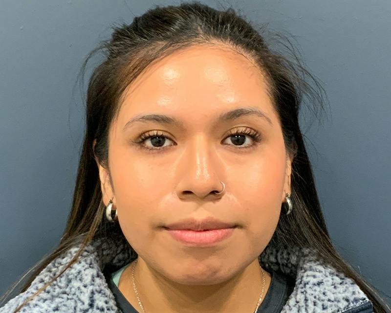 Rhinoplasty Before & After Gallery - Patient 140794 - Image 1