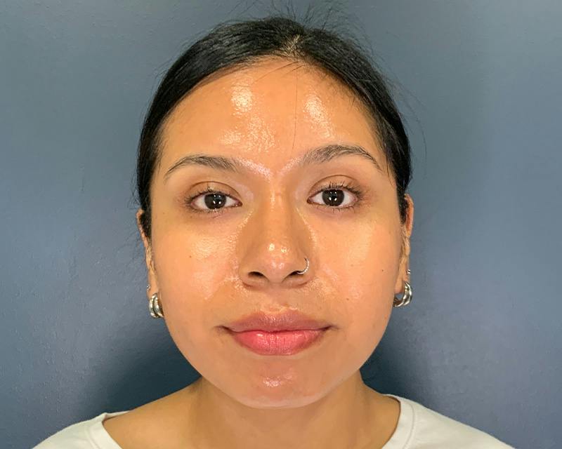 Rhinoplasty Before & After Gallery - Patient 140794 - Image 2