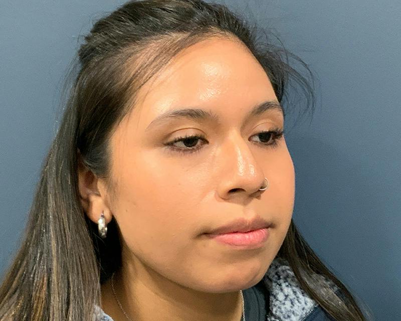 Rhinoplasty Before & After Gallery - Patient 140794 - Image 5