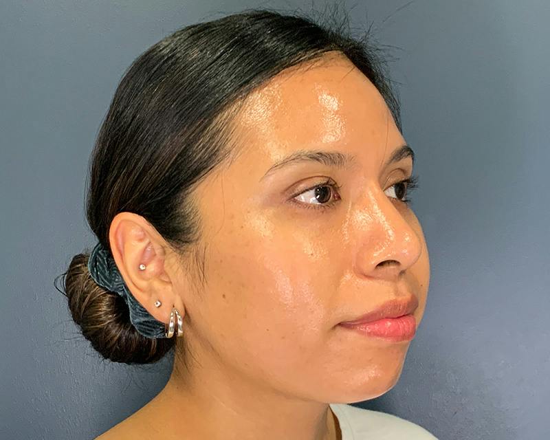 Rhinoplasty Before & After Gallery - Patient 140794 - Image 6