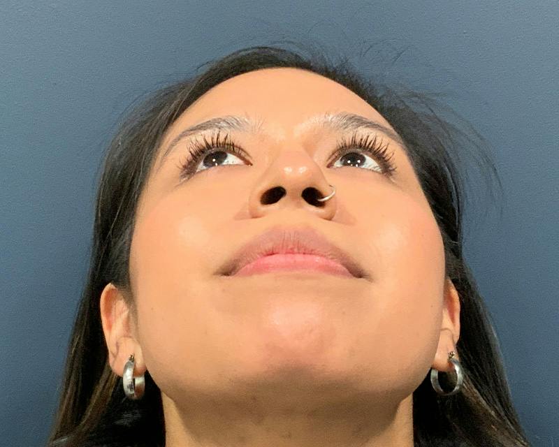 Rhinoplasty Before & After Gallery - Patient 140794 - Image 3