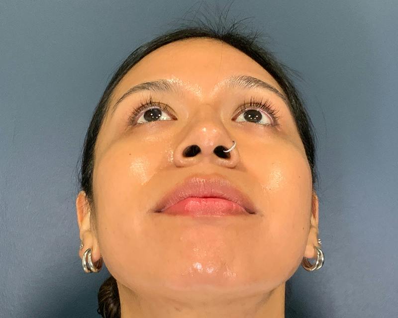 Rhinoplasty Before & After Gallery - Patient 140794 - Image 4