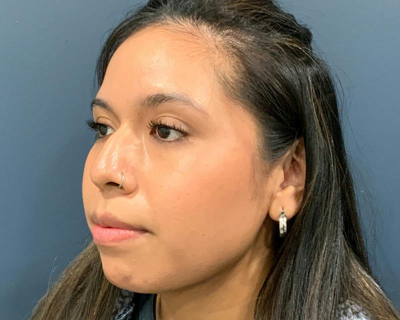 Rhinoplasty Before & After Gallery - Patient 140794 - Image 7