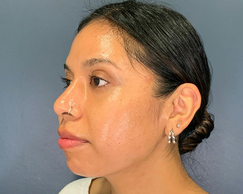 Rhinoplasty Before & After Gallery - Patient 140794 - Image 8
