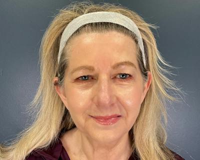 Rhinoplasty Before & After Gallery - Patient 344324 - Image 1