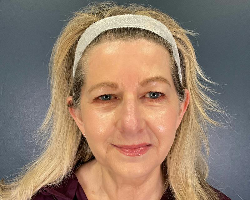 Rhinoplasty Before & After Gallery - Patient 344324 - Image 1