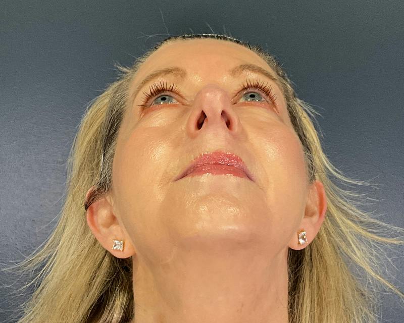 Rhinoplasty Before & After Gallery - Patient 344324 - Image 3