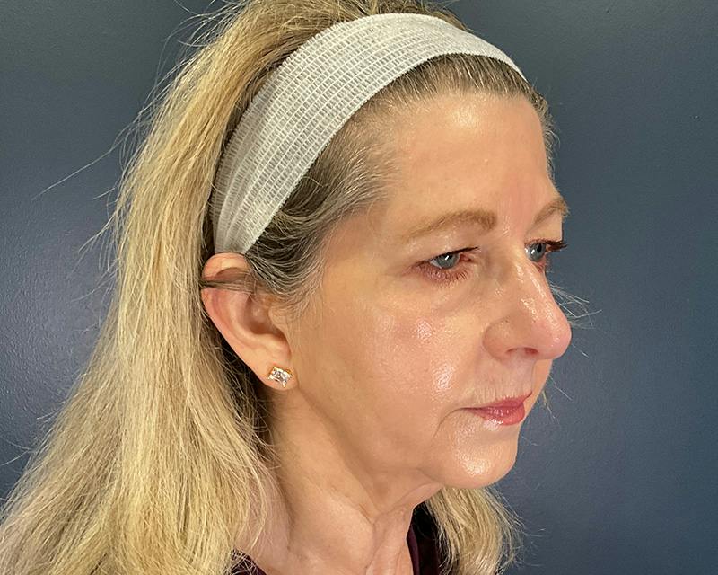 Rhinoplasty Before & After Gallery - Patient 344324 - Image 5