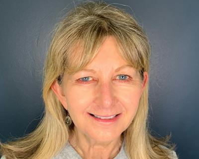 Rhinoplasty Before & After Gallery - Patient 344324 - Image 2