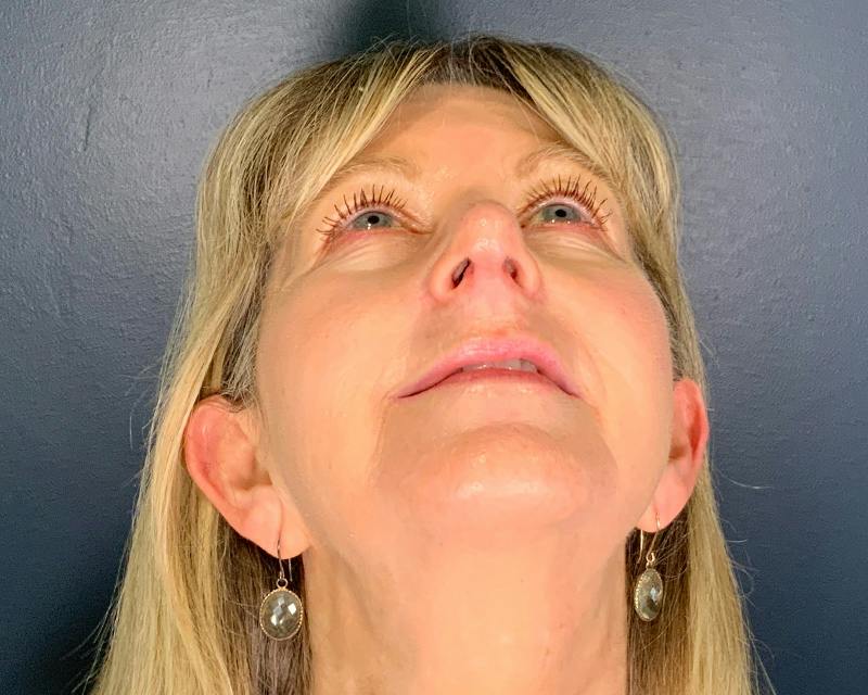 Rhinoplasty Before & After Gallery - Patient 344324 - Image 4